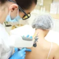 Czas na zmiany – jak działa zabieg laserowego usuwania tatuażu?